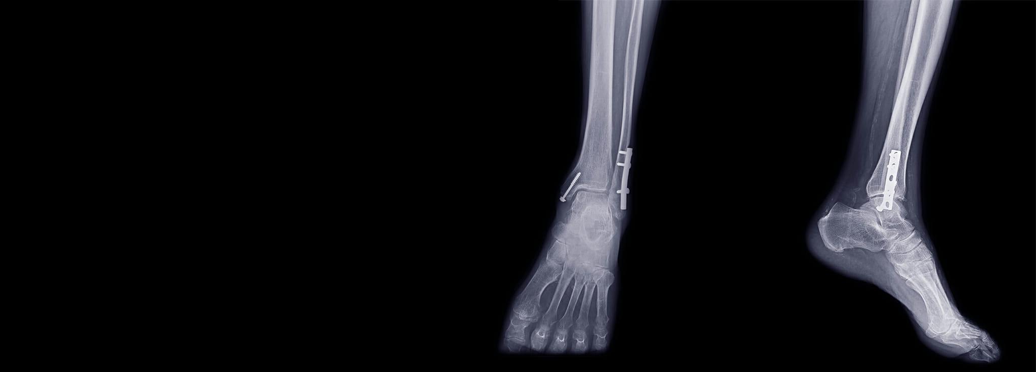 装有医用植入物和螺钉的足部x光片